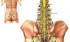 Hội chứng đuôi ngựa và những hệ lụy