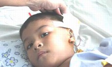 Khắc phục dị tật không có vành tai