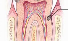 Sâu răng & các yếu tố nguy cơ