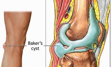 Bệnh ở bao hoạt dịch khớp gối