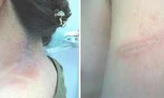 Nhầm lẫn giữa bệnh zona và viêm da do côn trùng