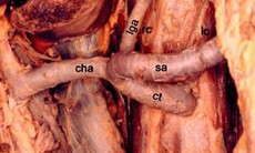 Hội chứng động mạch mạc treo tràng trên - Ai dễ mắc?