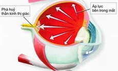 Phòng tránh mù lòa do bệnh glôcôm