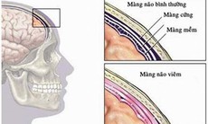 Lao màng não dễ bị bỏ qua, vì sao?