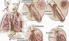 Triệu chứng bệnh phổi tắc nghẽn mạn tính