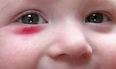 Xử lý chấn thương mắt ở trẻ em