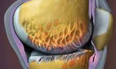 Glucosamin - Dùng sao cho đúng?