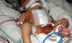 Bé Cu đã được phẫu thuật chuyển gốc động mạch