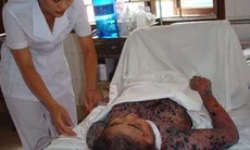 Bạn có biết bệnh Pemphigus?