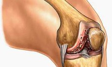 Có phải “thấp khớp đớp vào tim”?