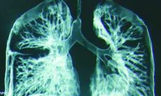 Phương pháp đặt stent chữa hẹp khí quản