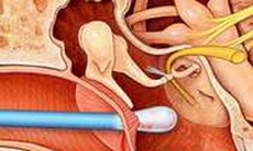 Dấu hiệu nhận biết khi bị thủng màng nhĩ
