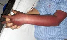 Tìm cơ hội sống cho người bệnh máu khó đông