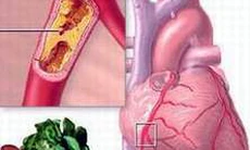 Thuốc điều trị suy mạch vành