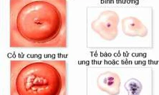 Xác định gen làm tăng nguy cơ ung thư tử cung