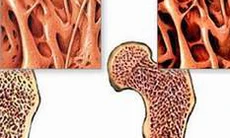 Thay khớp háng ở người lớn tuổi