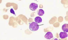 Thalidomide trong điều trị bệnh đa u tủy xương