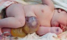 Thoát vị rốn