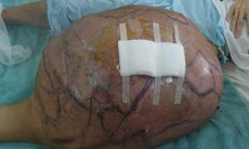 Bệnh viện ung bướu TP.HCM: 2 ngày xử lý 3 ca bướu khổng lồ