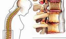 Viêm cột sống dính khớp, uống thuốc gì?