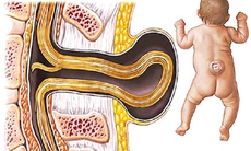 Vai trò của chất sắt và acid folic trong thai kỳ