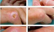 Bạn biết gì về bệnh xơ cứng bì toàn thể?
