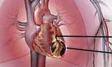 Những điều cần lưu ý ở người mắc bệnh tim