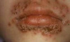 Thuốc chữa herpes môi