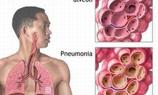 Phòng ngừa viêm đường hô hấp cấp do virut