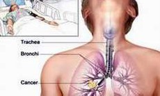 Tìm hiểu về hóa trị liệu