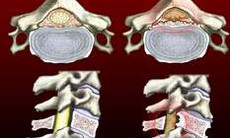 Bài 11: Hẹp ống sống thắt lưng