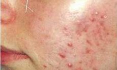 Thuốc điều trị bệnh trứng cá