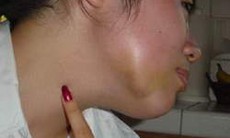 Viêm tuyến mang tai dễ gặp trong mùa đông