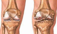 Viêm khớp do lậu cầu