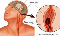 Thuốc phục hồi liệt cơ sau tai biến mạch máu não