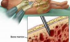 Bệnh u lympho ác tính không Hodgkin - Những điều cần biết