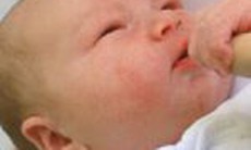 Chàm sữa có chữa khỏi không?