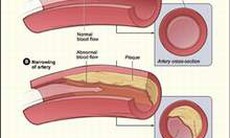 Nhóm thuốc statin điều trị rối loạn mỡ máu
