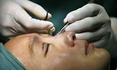 Điều cần biết về phẫu thuật sụp mi mắt, xăm mi và xóa nếp nhăn mắt