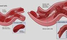 Tế bào gốc chữa khỏi bệnh thiếu máu hồng cầu hình liềm