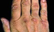 Điều trị bệnh viêm đa cơ - viêm da cơ