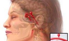 Nút mạch dị dạng bằng keo sinh học