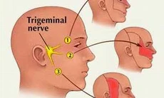 Thuốc trị đau dây thần kinh sinh ba
