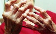 Viêm khớp dạng thấp: Thận trọng với các thuốc ức chế miễn dịch