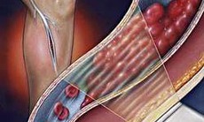 Đông y trị viêm tắc tĩnh mạch