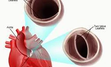 Nguy cơ do hẹp van động mạch chủ