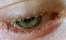 Viêm nhiễm bờ mi mắt, điều trị thế nào?