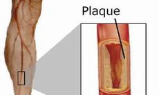 Mối nguy hiểm do viêm tắc động mạch