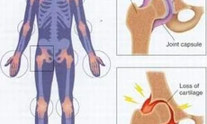 Điều trị viêm khớp thiếu niên tự phát