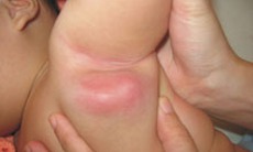 Viêm hạch ở trẻ
